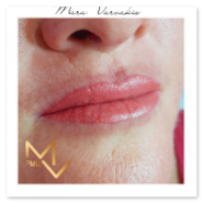 Μόνιμο μακιγιάζ χειλιών / Permanent lip makeup